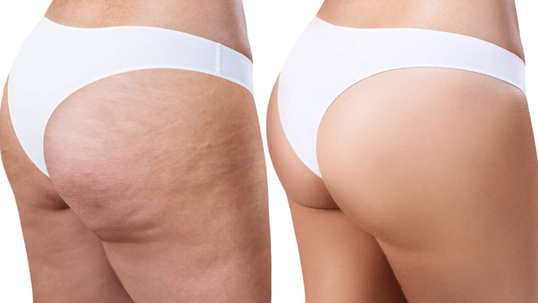 cropped-exilis-ultra-360.jpg