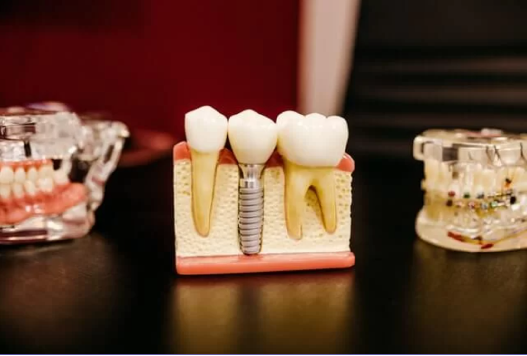 implant-dentar2.png