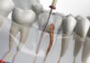 Tratamentul endodontic – salvarea dinților afectați